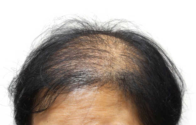बाल किन बीमारियों से झड़ते हैं? - Which diseases causes hair loss in Hindi