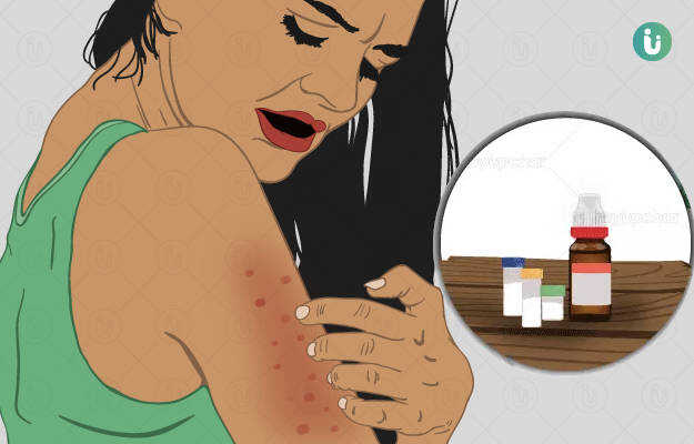 Homeopathic Medicine and Treatment for Skin Allergy