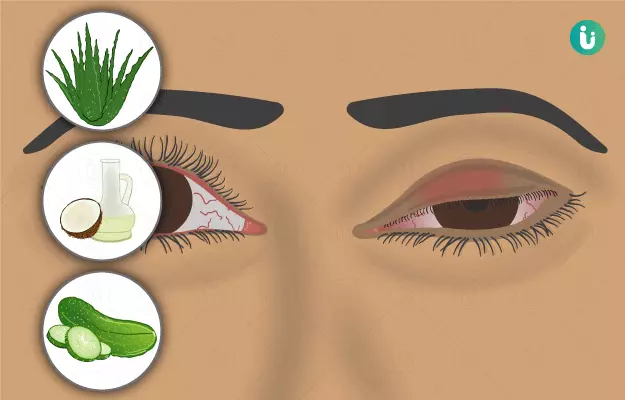आंखों की सूजन के घरेलू उपाय - Home Remedies for Puffy Eyes in Hindi