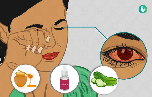 आंखों की एलर्जी के घरेलू उपाय - Home remedies for eye allergy in Hindi