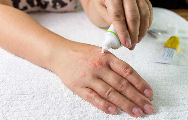 What to apply for eczema