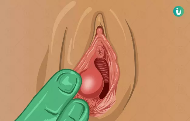 योनि में गांठ (फुंसी) - Vaginal Cyst in Hindi