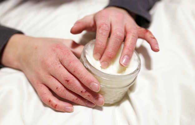 Creams for cracked hand skin