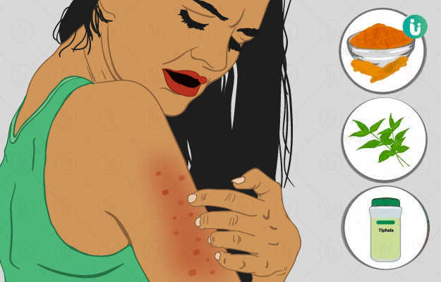 Ayurvedic medicine and treatment for skin allergy