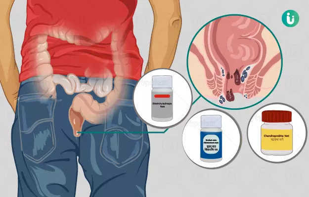 खूनी बवासीर का आयुर्वेदिक इलाज और दवा - Ayurvedic treatment and medicine for bleeding piles in Hindi