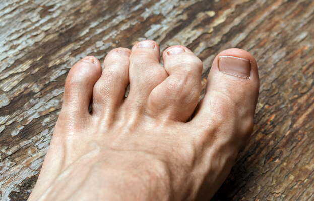 Homeopathic Medicine for Gout: Natural Relief and Healing