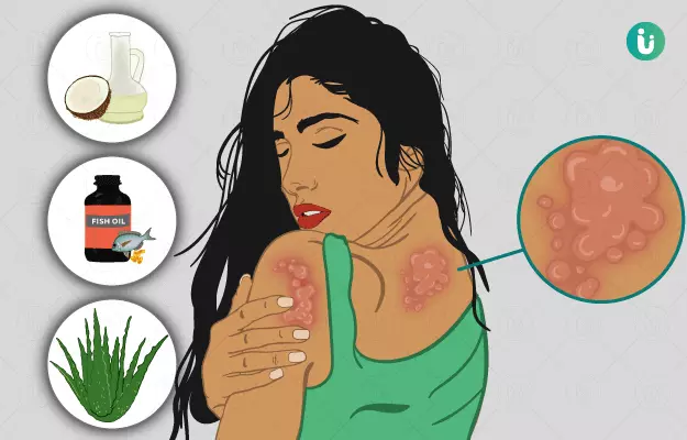 पित्ती के घरेलू उपाय - Home Remedies for Hives in hindi
