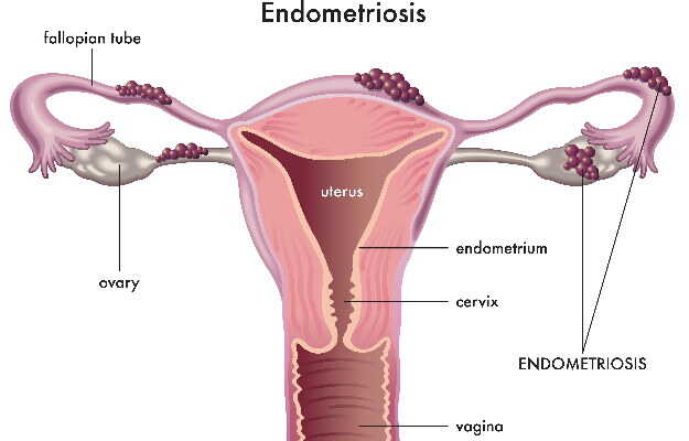 बच्चेदानी में सूजन के घरेलू उपाय - Home remedies for endometriosis in Hindi