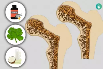 Fight Osteoporosis with These Easy and Natural Home Remedies