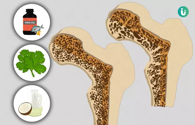हड्डियों को मजबूत बनाने के घरेलू उपाय  - Home Remedies for Osteoporosis in Hindi