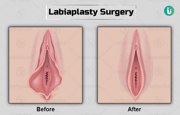 लेबियाप्लास्टी - Labiaplasty in Hindi