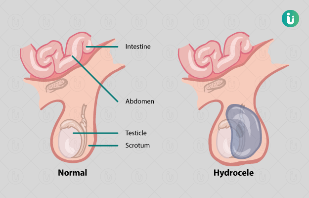 हाइड्रोसील का ऑपरेशन - Hydrocele surgery in Hindi