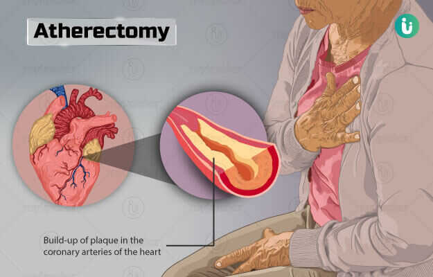एथेरेक्टॉमी - Atherectomy in Hindi