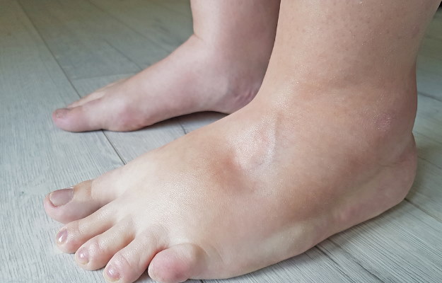What to eat and avoid in swelling