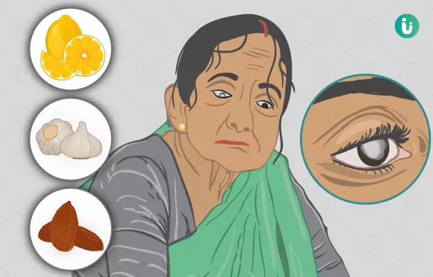 मोतियाबिंद (सफेद मोतिया) के घरेलू उपाय - Home Remedies for Cataract in Hindi