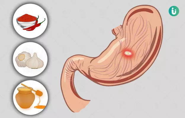 पेट में अल्सर के घरेलू उपाय - Home Remedies for Stomach Ulcer in Hindi