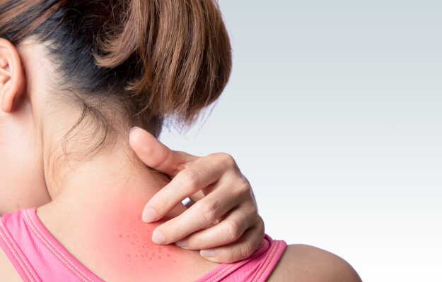Beat the Heat: How to Treat and Prevent Heat Rash