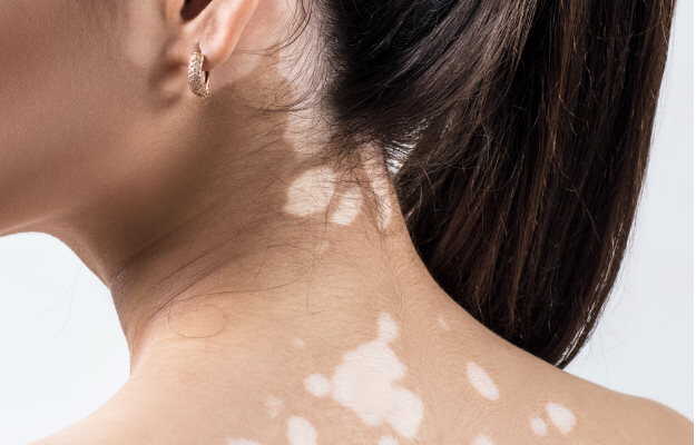 सफेद दाग हटाने की क्रीम - Vitiligo creams in Hindi