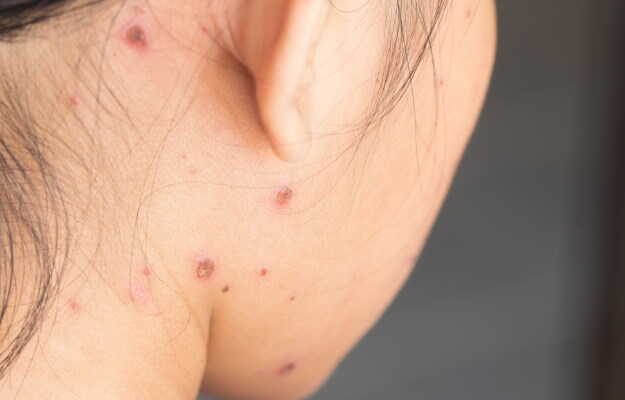 Pain Relief and Itch Control: Allopathic Medicines for Chickenpox