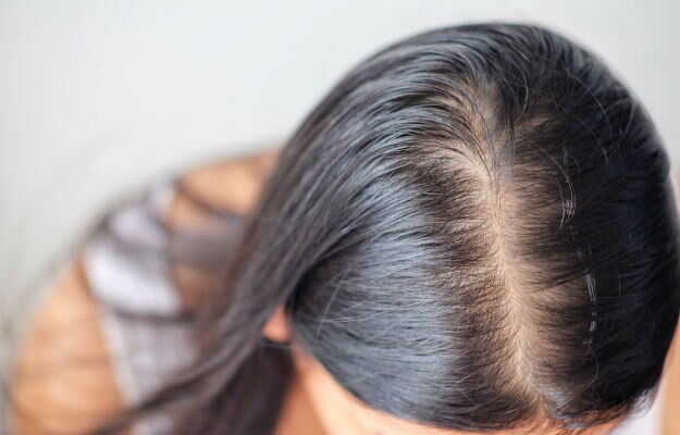 पीसीओएस में बाल क्यों झड़ते हैं, लक्षण, कारण व इलाज - PCOS Hair Loss:  Symptoms, Causes and Treatment in Hindi
