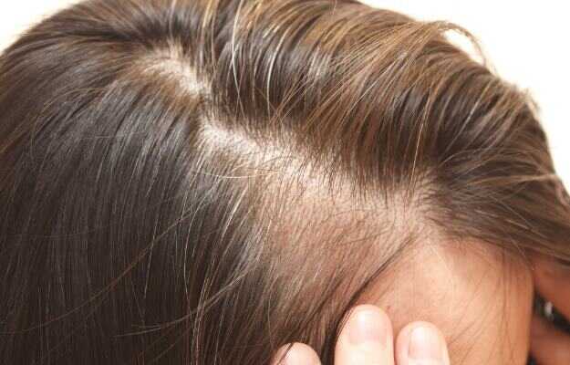 मेनोपॉज में बाल झड़ने के कारण व इलाज - Menopause hair loss causes and treatment in Hindi