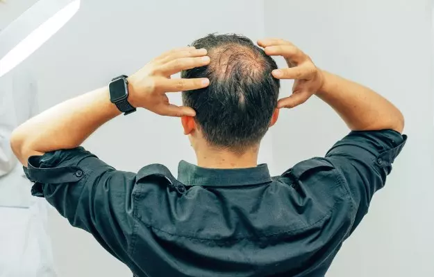 Is Baldness Preventable?
