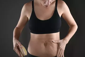 How to Get Rid of Loose Skin After Losing Weight