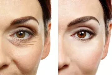 Different Types of Wrinkles and How to Combat Them