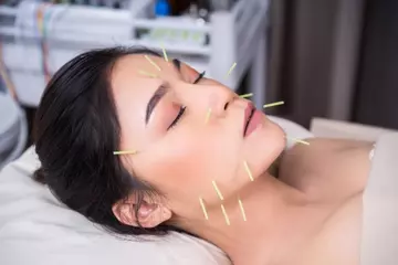 Needles of Youth: Exploring the Anti-Aging Benefits of Facial Acupuncture
