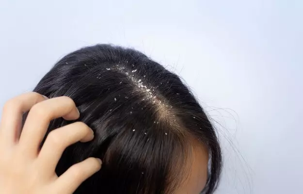 क्या डैंड्रफ से बाल झड़ते हैं? - Can dandruff cause hair loss in Hindi