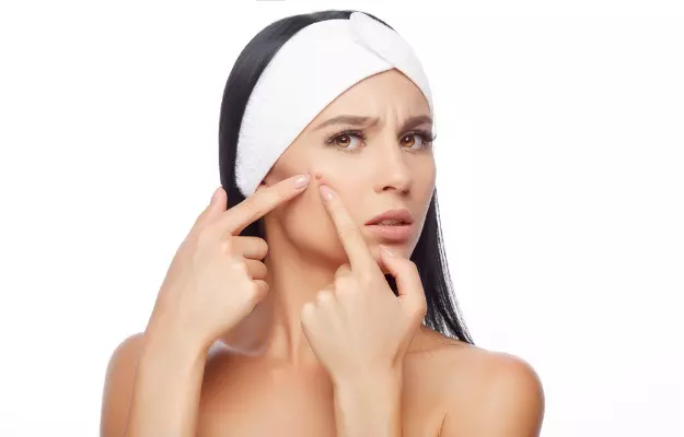 मुंहासे के आयुर्वेदिक उपाय - Ayurvedic remedies for pimples in Hindi