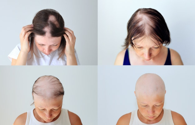 Female Pattern Baldness Stages Symptoms Causes And Treatment