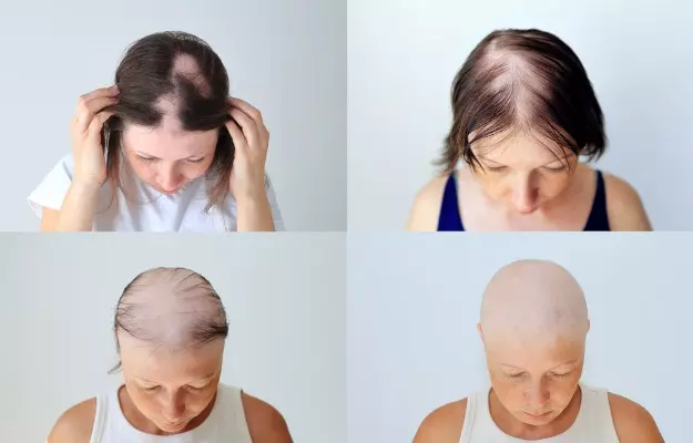 महिलाओं में गंजेपन के लक्षण, कारण व इलाज - Female pattern baldness in Hindi 