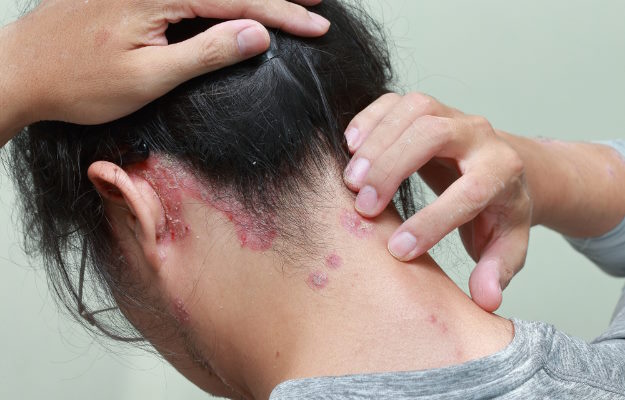 Stress Rash: Effects, and T...