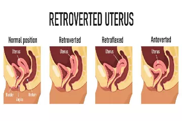 Know About Retroverted Uterus For Women Health 