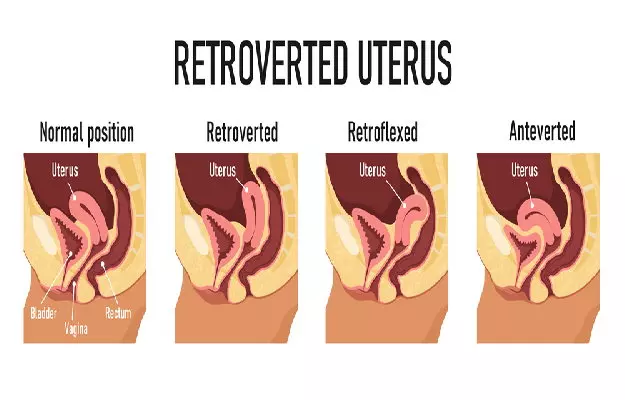 झुका हुआ गर्भाशय  - Retroverted Uterus in hindi 