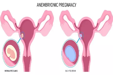 Know About Anembryonic Pregnancy