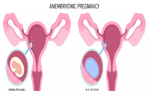 एनब्रायोनिक गर्भावस्था - anembryonic pregnancy in hindi 