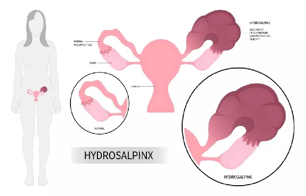 हाइड्रोसाल्पिनक्स - Hydrosalpinx in hindi