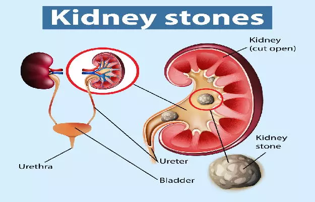 गुर्दे की पथरी: प्राकृतिक उपचार और बचाव के उपाय - Protecting Your Kidneys: Know How to Prevent Kidney Stones in Hindi  