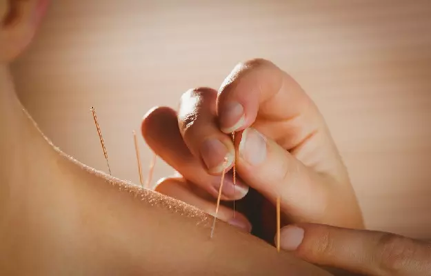 Needle Your Way to a Leaner Body: The Benefits of Acupuncture for Weight Loss