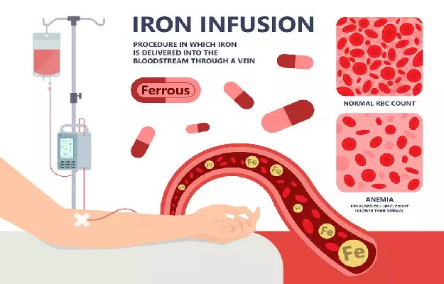 आयरन इन्फ्यूजन थेरेपी: रक्त की कमी से निपटने का एक प्रभावी तरीका - Iron Infusion Therapy: An Effective Way to Deal with Blood Deficiency in Hindi