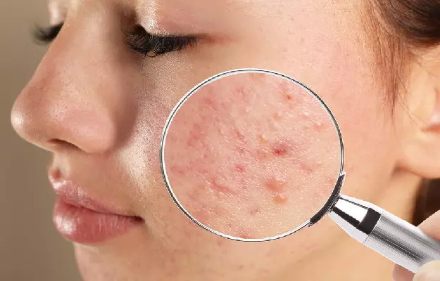 जानिए एक्ने प्रोन स्किन के बारे में  - Know About Acne Prone Skin in Hindi 