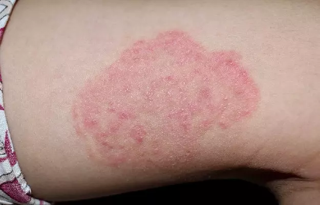 Tea Tree Oil: A Natural Remedy for Ringworm Treatment