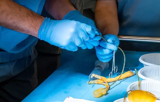 लिंग को बड़ा करने के लिए सर्जरी  - Penile Enlargement Surgery in Hindi 