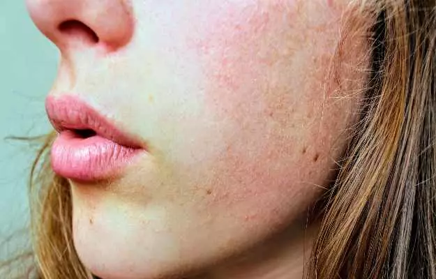 चेहरे के रोम छिद्र भरने के उपाय और इलाज - Remedy and cure to treat open skin pores in hindi