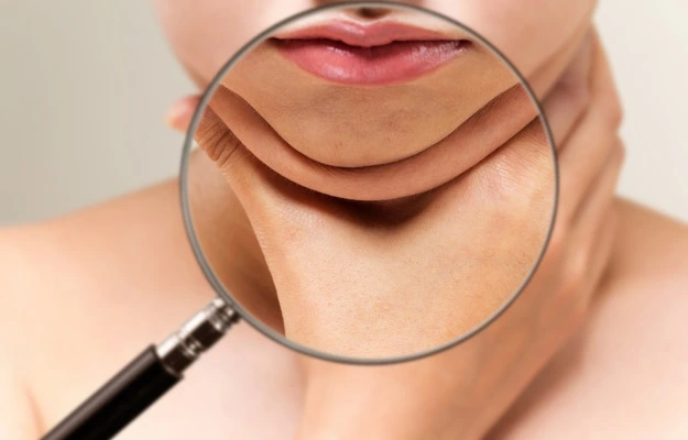 What is Double Chin, How to Remove Double Chin, Home Remedies to Get Rid of Double Chin