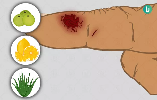 घाव के निशान और दाग मिटाने के तरीके - How to get rid of scars in hindi