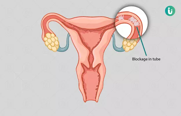 Blocked Fallopian Tubes: Diagnosis for Improved Reproductive Health