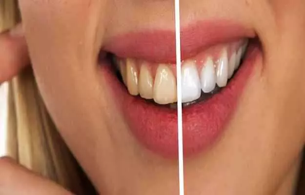 3 मिनट में सफेद और सुंदर दाँत पाने के घरेलू नुस्खे